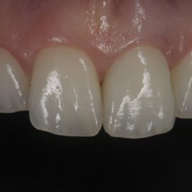 0implant3  2  71 270 270 80 c