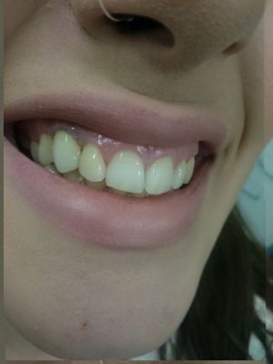 implant11 69 800 600 80