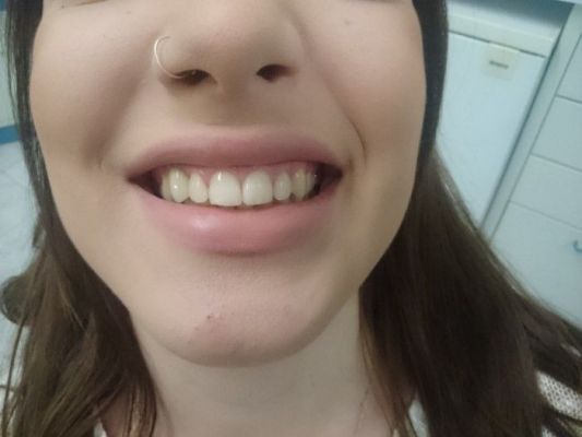 implant12 68 800 600 80