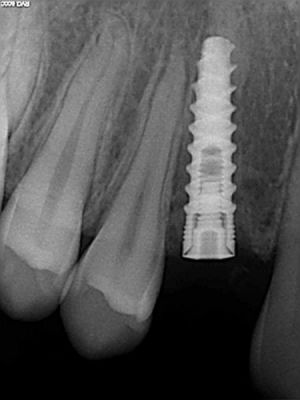implant13 67 800 600 80