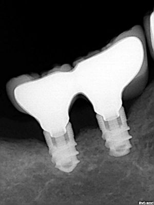 implant22 63 800 600 80