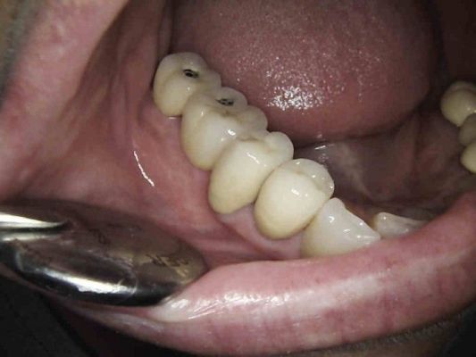 implant23 64 800 600 80
